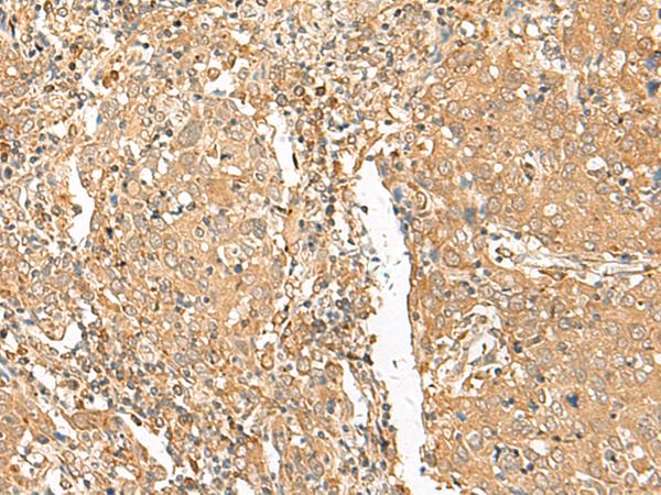 GOLGA6A Antibody - Immunohistochemistry of paraffin-embedded Human cervical cancer tissue  using GOLGA6A Polyclonal Antibody at dilution of 1:50(×200)