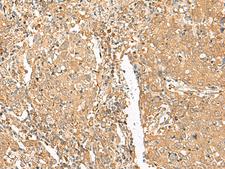 GOLGA6A Antibody - Immunohistochemistry of paraffin-embedded Human cervical cancer tissue  using GOLGA6A Polyclonal Antibody at dilution of 1:50(×200)