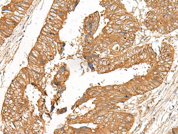 GOLGA6A Antibody - Immunohistochemistry of paraffin-embedded Human colorectal cancer tissue  using GOLGA6A Polyclonal Antibody at dilution of 1:50(×200)
