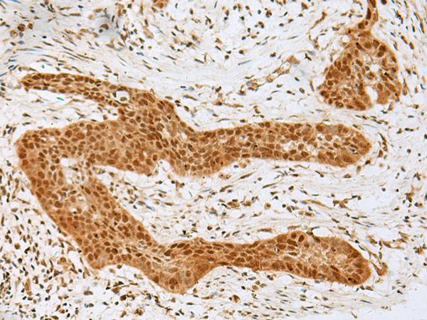 GOLGA7 Antibody - Immunohistochemistry of paraffin-embedded Human esophagus cancer tissue  using GOLGA7 Polyclonal Antibody at dilution of 1:40(×200)