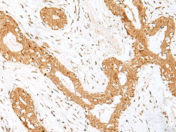 GOLGA7 Antibody - Immunohistochemistry of paraffin-embedded Human breast cancer tissue  using GOLGA7 Polyclonal Antibody at dilution of 1:40(×200)