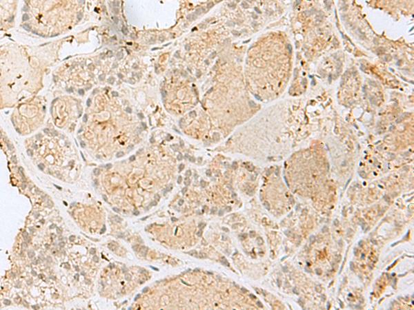 GOLGA7 Antibody - Immunohistochemistry of paraffin-embedded Human thyroid cancer tissue  using GOLGA7 Polyclonal Antibody at dilution of 1:40(×200)