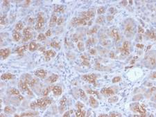 Golgi Zone Antibody - Formalin-fixed, paraffin-embedded human Breast Carcinoma stained with Golgi Rabbit Recombinant Monoclonal Antibody (GLG1/2829R).