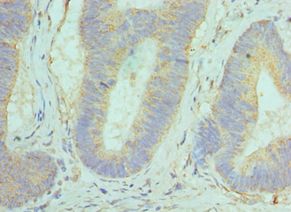 GOLM1 / GP73 / GOLPH2 Antibody - Immunohistochemistry of paraffin-embedded human colon cancer using antibody at 1:100 dilution.