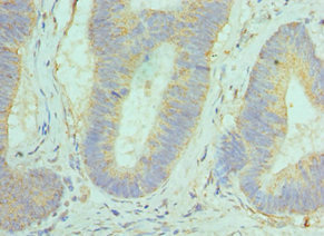 GOLM1 / GP73 / GOLPH2 Antibody - Immunohistochemistry of paraffin-embedded human colon cancer using GOLM1 Antibody at dilution of 1:100