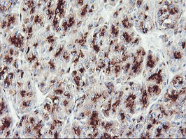 GOLM1 / GP73 / GOLPH2 Antibody - IHC of paraffin-embedded Carcinoma of Human liver tissue using anti-GOLM1 mouse monoclonal antibody.