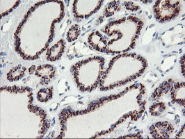 GOLM1 / GP73 / GOLPH2 Antibody - IHC of paraffin-embedded Carcinoma of Human thyroid tissue using anti-GOLM1 mouse monoclonal antibody.