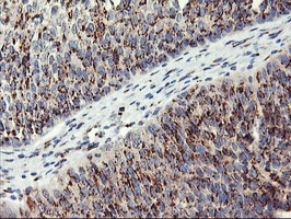 GOLM1 / GP73 / GOLPH2 Antibody - IHC of paraffin-embedded Carcinoma of Human bladder tissue using anti-GOLM1 mouse monoclonal antibody.