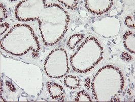 GOLM1 / GP73 / GOLPH2 Antibody - IHC of paraffin-embedded Carcinoma of Human thyroid tissue using anti-GOLM1 mouse monoclonal antibody.