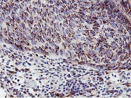 GOLM1 / GP73 / GOLPH2 Antibody - IHC of paraffin-embedded Carcinoma of Human bladder tissue using anti-GOLM1 mouse monoclonal antibody.