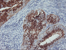 GOLM1 / GP73 / GOLPH2 Antibody - IHC of paraffin-embedded Adenocarcinoma of Human endometrium tissue using anti-GOLM1 mouse monoclonal antibody.