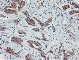 GOLM1 / GP73 / GOLPH2 Antibody - IHC of paraffin-embedded Carcinoma of Human lung tissue using anti-GOLM1 mouse monoclonal antibody.