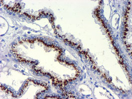 GOLM1 / GP73 / GOLPH2 Antibody - IHC of paraffin-embedded Carcinoma of Human prostate tissue using anti-GOLM1 mouse monoclonal antibody.