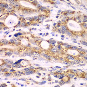GOLM1 / GP73 / GOLPH2 Antibody - Immunohistochemistry of paraffin-embedded human gastric cancer using GOLM1 antibody at dilution of 1:100 (40x lens).