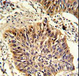 GOLPH3 Antibody - Formalin-fixed and paraffin-embedded human lung carcinoma with GOLPH3 Antibody , which was peroxidase-conjugated to the secondary antibody, followed by DAB staining. This data demonstrates the use of this antibody for immunohistochemistry; clinical relevance has not been evaluated.