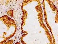 GOLPH3 Antibody - Immunohistochemistry image of paraffin-embedded human prostate cancer at a dilution of 1:100