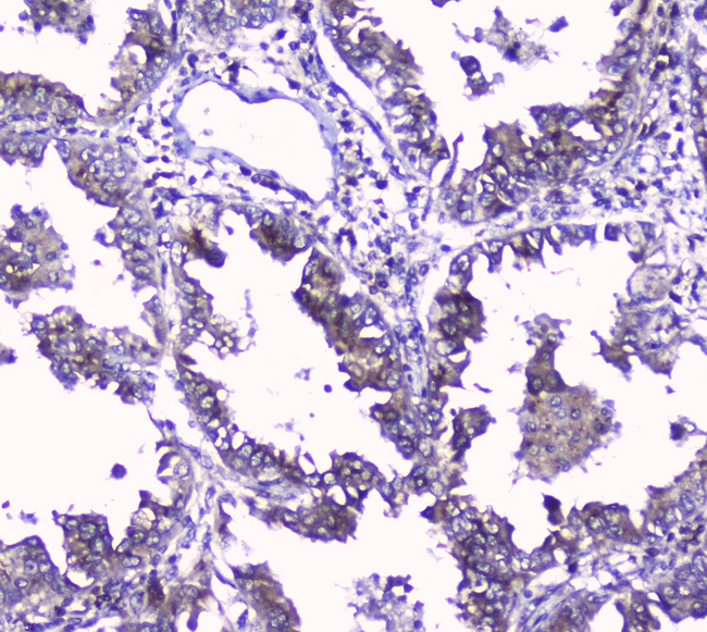 GOLPH3 Antibody - IHC analysis of GOLPH3 using anti-GOLPH3 antibody. GOLPH3 was detected in paraffin-embedded section of human lung cancer tissue. Heat mediated antigen retrieval was performed in citrate buffer (pH6, epitope retrieval solution) for 20 mins. The tissue section was blocked with 10% goat serum. The tissue section was then incubated with 2µg/ml rabbit anti-GOLPH3 Antibody overnight at 4°C. Biotinylated goat anti-rabbit IgG was used as secondary antibody and incubated for 30 minutes at 37°C. The tissue section was developed using Strepavidin-Biotin-Complex (SABC) with DAB as the chromogen.