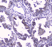 GOLPH3 Antibody - IHC staining of FFPE human lung cancer with GOLPH3 antibody at 2ug/ml. HIER: boil tissue sections in pH6, 10mM citrate buffer, for 10-20 min followed by cooling at RT for 20 min.