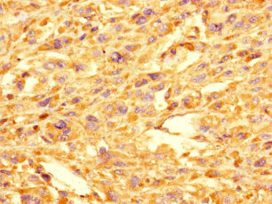 GOLPH3L Antibody - Immunohistochemistry of paraffin-embedded human melanoma using GOLPH3L Antibody at dilution of 1:100