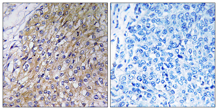 GOLT1A Antibody - Immunohistochemistry analysis of paraffin-embedded human breast carcinoma tissue, using GOLT1A Antibody. The picture on the right is blocked with the synthesized peptide.
