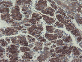 GORAB / SCYL1BP1 Antibody - IHC of paraffin-embedded Carcinoma of Human liver tissue using anti-GORAB mouse monoclonal antibody. (Heat-induced epitope retrieval by 10mM citric buffer, pH6.0, 100C for 10min).