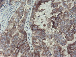 GORAB / SCYL1BP1 Antibody - IHC of paraffin-embedded Adenocarcinoma of Human ovary tissue using anti-GORAB mouse monoclonal antibody. (Heat-induced epitope retrieval by 10mM citric buffer, pH6.0, 100C for 10min).