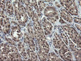 GORAB / SCYL1BP1 Antibody - IHC of paraffin-embedded Carcinoma of Human thyroid tissue using anti-GORAB mouse monoclonal antibody.