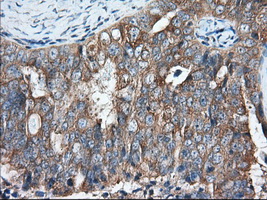 GORASP1 / GRASP65 Antibody - Immunohistochemical staining of paraffin-embedded Adenocarcinoma of Human ovary tissue using anti-GORASP1 mouse monoclonal antibody. (Dilution 1:50).