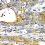 GORASP1 / GRASP65 Antibody - Immunohistochemistry of paraffin-embedded human gastric cancer tissue.