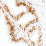 GORASP2 / GRASP55 Antibody - Detection of human GRASP55 by immunohistochemistry. Sample: FFPE section of human prostate carcinoma. Antibody: Affinity purified rabbit anti- GRASP55 used at a dilution of 1:1,000 (1µg/ml). Detection: DAB