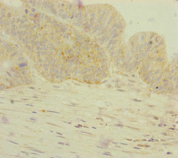GORASP2 / GRASP55 Antibody - Immunohistochemistry of paraffin-embedded human colon cancer at dilution of 1:100
