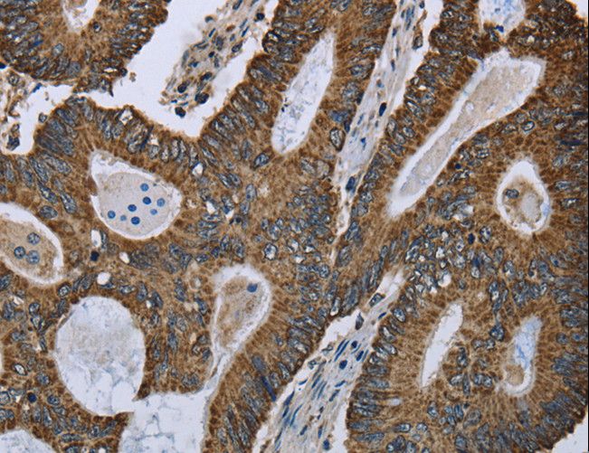 GOT2 Antibody - Immunohistochemistry of paraffin-embedded Human colon cancer using GOT2 Polyclonal Antibody at dilution of 1:50.