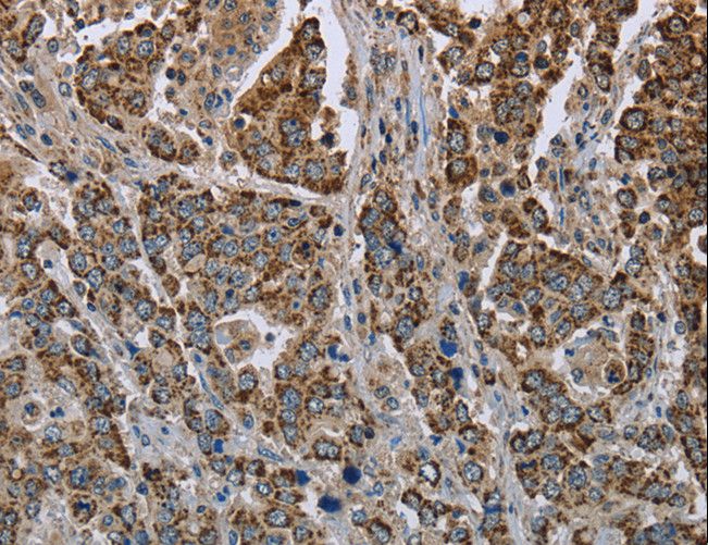 GOT2 Antibody - Immunohistochemistry of paraffin-embedded Human liver cancer using GOT2 Polyclonal Antibody at dilution of 1:50.