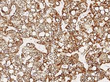 GOT2 Antibody - Immunochemical staining GOT2 in human hepatoma with rabbit polyclonal antibody at 1:1000 dilution, formalin-fixed paraffin embedded sections.