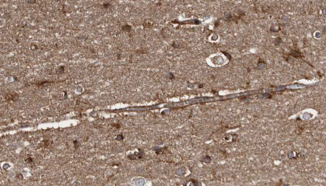 GP1BB / CD42c Antibody - 1:100 staining human brain carcinoma tissue by IHC-P. The sample was formaldehyde fixed and a heat mediated antigen retrieval step in citrate buffer was performed. The sample was then blocked and incubated with the antibody for 1.5 hours at 22°C. An HRP conjugated goat anti-rabbit antibody was used as the secondary.