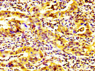 GP6 / GPVI Antibody - Immunohistochemistry image at a dilution of 1:600 and staining in paraffin-embedded human bladder cancer performed on a Leica BondTM system. After dewaxing and hydration, antigen retrieval was mediated by high pressure in a citrate buffer (pH 6.0) . Section was blocked with 10% normal goat serum 30min at RT. Then primary antibody (1% BSA) was incubated at 4 °C overnight. The primary is detected by a biotinylated secondary antibody and visualized using an HRP conjugated SP system.