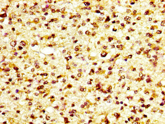 GP6 / GPVI Antibody - Immunohistochemistry image at a dilution of 1:600 and staining in paraffin-embedded human glioma cancer performed on a Leica BondTM system. After dewaxing and hydration, antigen retrieval was mediated by high pressure in a citrate buffer (pH 6.0) . Section was blocked with 10% normal goat serum 30min at RT. Then primary antibody (1% BSA) was incubated at 4 °C overnight. The primary is detected by a biotinylated secondary antibody and visualized using an HRP conjugated SP system.