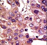 GP78 / AMFR Antibody - Formalin-fixed and paraffin-embedded human cancer tissue reacted with the primary antibody, which was peroxidase-conjugated to the secondary antibody, followed by DAB staining. This data demonstrates the use of this antibody for immunohistochemistry; clinical relevance has not been evaluated. BC = breast carcinoma; HC = hepatocarcinoma.