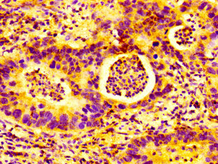 GP78 / AMFR Antibody - Immunohistochemistry image at a dilution of 1:100 and staining in paraffin-embedded human bladder cancer performed on a Leica BondTM system. After dewaxing and hydration, antigen retrieval was mediated by high pressure in a citrate buffer (pH 6.0) . Section was blocked with 10% normal goat serum 30min at RT. Then primary antibody (1% BSA) was incubated at 4 °C overnight. The primary is detected by a biotinylated secondary antibody and visualized using an HRP conjugated SP system.