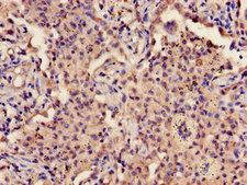 GP9 / CD42a Antibody - Immunohistochemistry image of paraffin-embedded human lung cancer at a dilution of 1:100