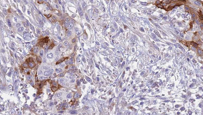 GP9 / CD42a Antibody - 1:100 staining human urothelial carcinoma tissue by IHC-P. The sample was formaldehyde fixed and a heat mediated antigen retrieval step in citrate buffer was performed. The sample was then blocked and incubated with the antibody for 1.5 hours at 22°C. An HRP conjugated goat anti-rabbit antibody was used as the secondary.