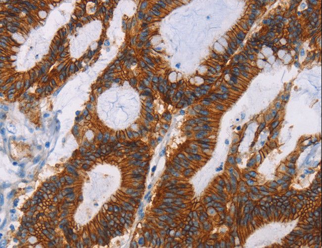 GPA33 / A33 Antibody - Immunohistochemistry of paraffin-embedded Human colon cancer using GPA33 Polyclonal Antibody at dilution of 1:30.