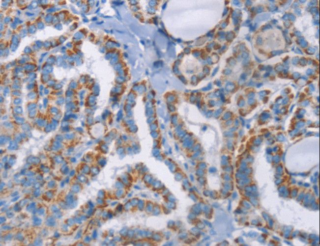 GPA33 / A33 Antibody - Immunohistochemistry of paraffin-embedded Human thyroid cancer using GPA33 Polyclonal Antibody at dilution of 1:30.
