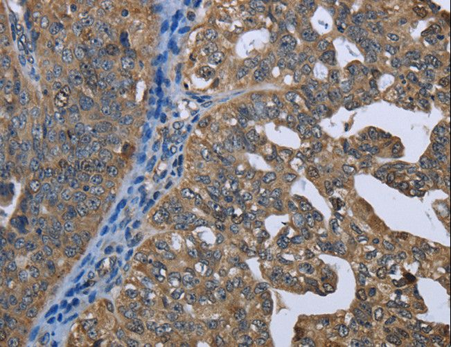 GPAM Antibody - Immunohistochemistry of paraffin-embedded Human gastric cancer using GPAM Polyclonal Antibody at dilution of 1:60.