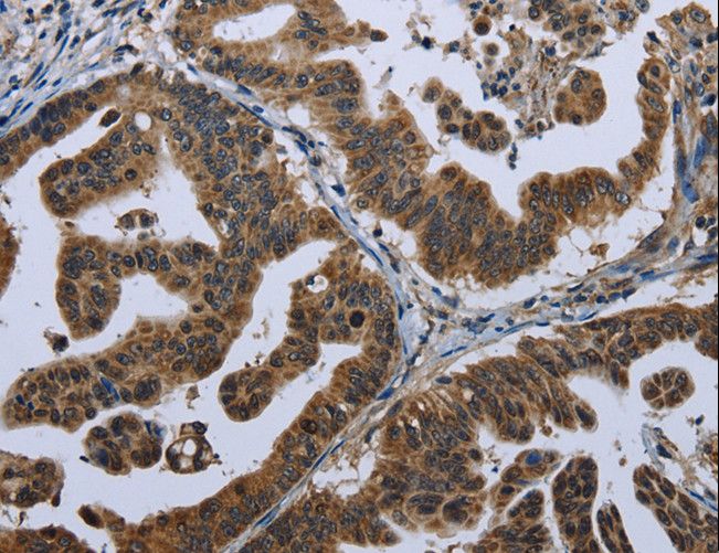 GPAM Antibody - Immunohistochemistry of paraffin-embedded Human gastric cancer using GPAM Polyclonal Antibody at dilution of 1:60.