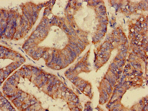 GPAM Antibody - Immunohistochemistry of paraffin-embedded human endometrial cancer at dilution of 1:100