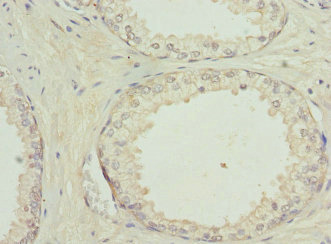 GPBB / PYGB Antibody - Immunohistochemistry of paraffin-embedded human prostate cancer using PYGB Antibody at dilution of 1:100