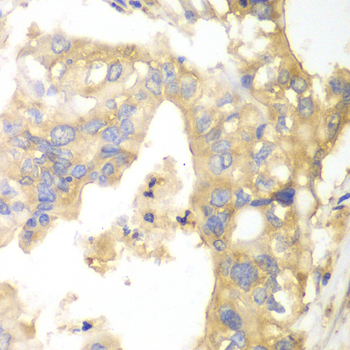 GPBB / PYGB Antibody - Immunohistochemistry of paraffin-embedded human liver cancer tissue.