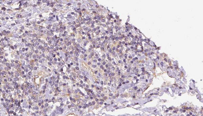 GPBB / PYGB Antibody - 1:100 staining human lymph carcinoma tissue by IHC-P. The sample was formaldehyde fixed and a heat mediated antigen retrieval step in citrate buffer was performed. The sample was then blocked and incubated with the antibody for 1.5 hours at 22°C. An HRP conjugated goat anti-rabbit antibody was used as the secondary.