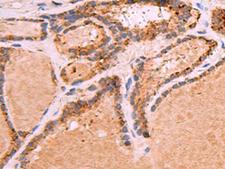 GPC2 / Glypican 2 Antibody - Immunohistochemistry of paraffin-embedded Human thyroid cancer tissue  using GPC2 Polyclonal Antibody at dilution of 1:35(×200)